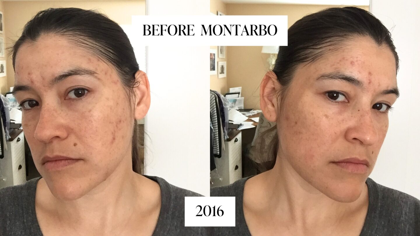 before montarbo skincare